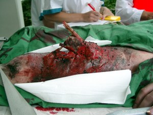 offener Oberschenkelbruch