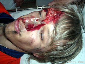 offene Kopfverletzung